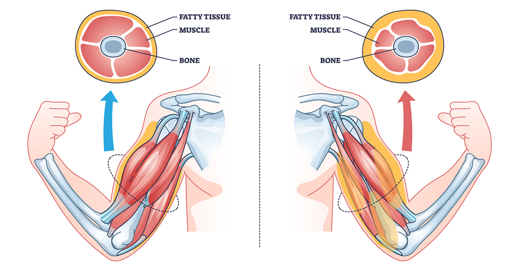 Sarcopenia as muscle mass loss and fatty tissue growth outline diagram stock